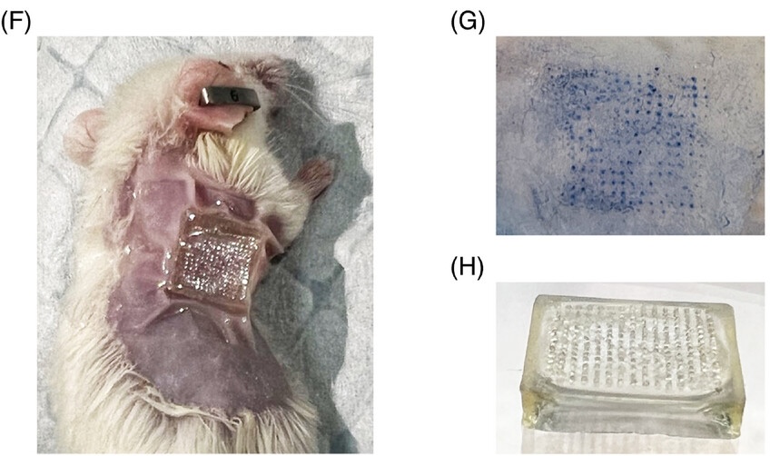 Targeting capacity, safety and efficacy of engineered extracellular vesicles delivered by transdermal microneedles to treat plasmacytoma in mice